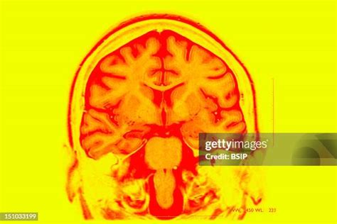 112 Epilepsy Mri Stock Photos, High-Res Pictures, and Images - Getty Images