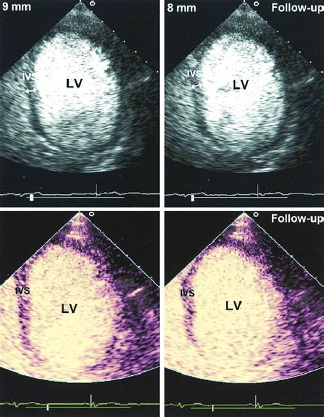 Two Dimensional Echocardiograms Showing End Diastolic Wall Thickness