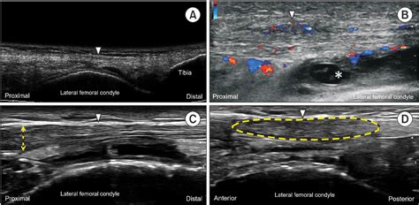 Figure 2 From The Role Of The Iliotibial Band Cross Sectional Area As A