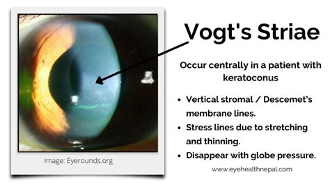 Cornea Iron Line On