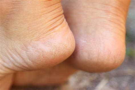 A Podiatrists Recommendations How To Get Rid Of Dry Cracked Feet