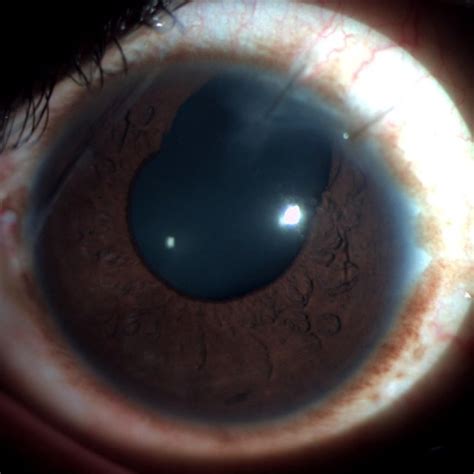 Slit Lamp Photograph Of The Anterior Segment Week Postoperatively