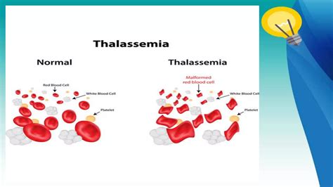 Thalassemia Case Presentation Ppt Free Download