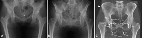 Pelvic Tilt Xray