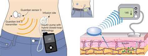 Closed Loop Insulin Pump Systems