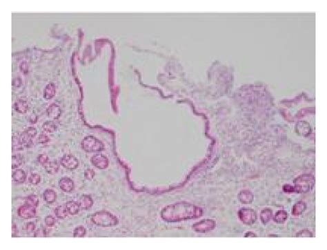 Histologic Findings Of Duodenal Biopsy The Duodenum Mucosa Shows A Download Scientific