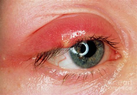 Stye On Upper Eyelid Photograph By Western Ophthalmic Hospital Science