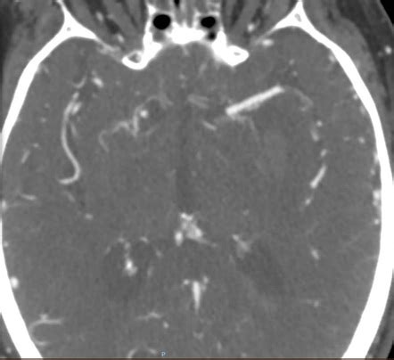 Intraventricular Extension Of Hemorrhagic Transformation Of MCA Infarct