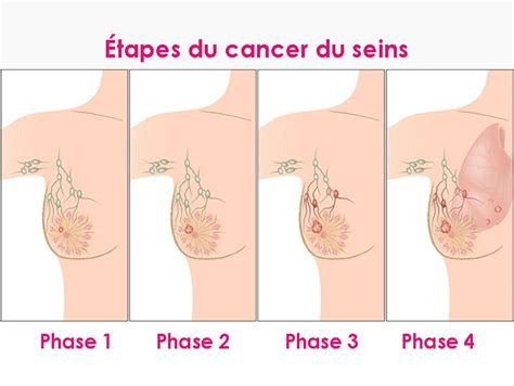 Lévolution du cancer du sein le cancer