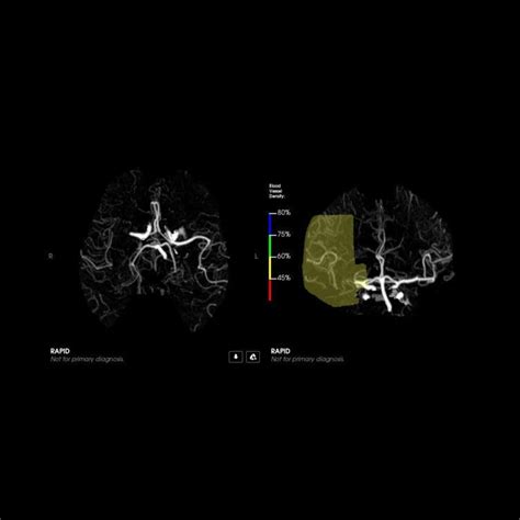 Logiciel M Dical Cta Rapidai Tdm Pour Angiographie De Traitement