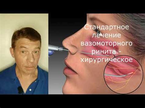 Вазомоторный ринит: почему операция не всегда эффективна - YouTube