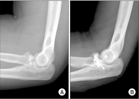 Coronoid Process Of Ulna Fracture