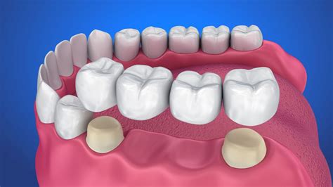 Mengenal Dental Bridge Gigi Palsu Permanen Yang Nyaman Digunakan