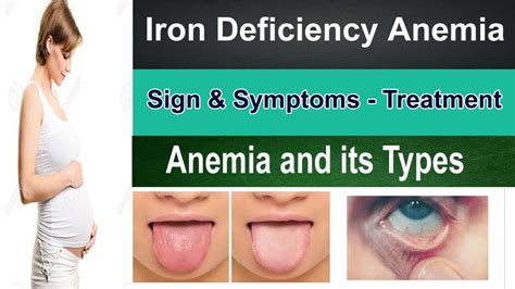 Iron Deficiency Anemia Sign Symptoms Treatment Anemia In Pregnancy