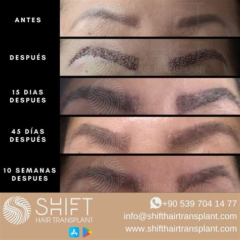 Horizonte Tienda De Comestibles Necesitar Implante De Cejas Antes Y