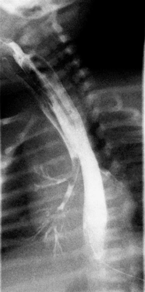 Esophageal Atresia X Ray