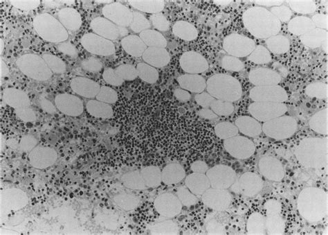 Morphologically Benign Lymphoid Aggregate In Trephine Biopsy Specimen