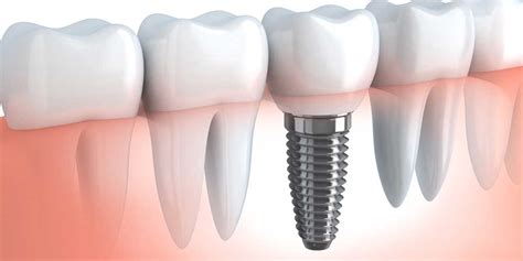 Dental Implants Osseointegration And Titanium Posts Leo A Tokarczyk