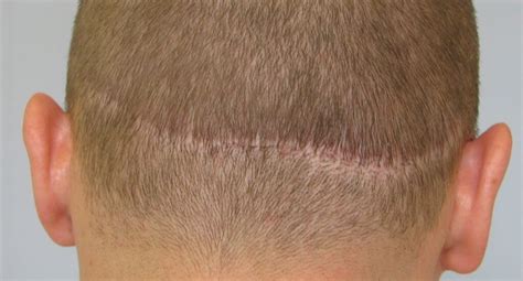 Hair Transplant Scars - FULL Micropigmentation