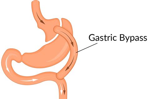 Laparoscopic Roux En Y Gastric Bypass Rygbp — Dr Marjan Jane