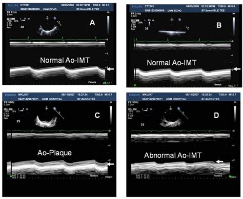 Aortic Intima Media Thickening And Plaques By TEE A B Short Axis A