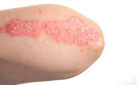 Tapinarof Cream Effective For Moderately Severe Plaque Psoriasis