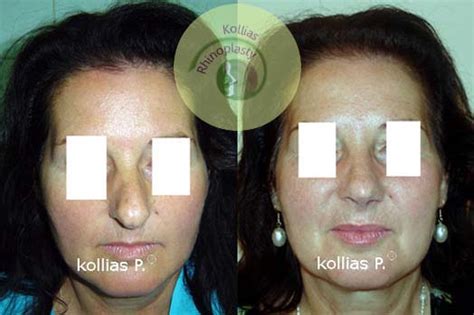 Rhinoplasty Over Development Nose 042 Π Κόλλιας