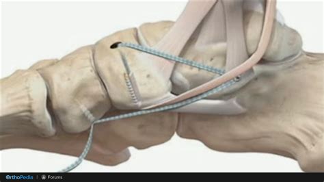 Internal Brace™ Ligament Augmentation Procedure Part 2—anterior