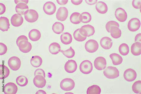 Target Cells With Abnormal Red Blood Cells In Blood Smear Specimen