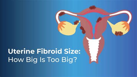 Uterine Fibroid Size: How Big Is Too Big | Shree IVF Clinic