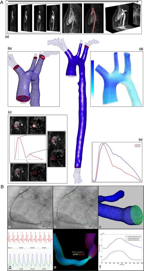 Computational Fluid Dynamics Modelling In Cardiovascular Medicine Heart