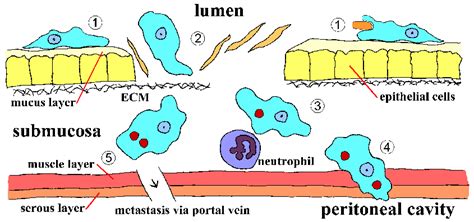 Entamoeba Histolytica Flask Shaped Ulcers