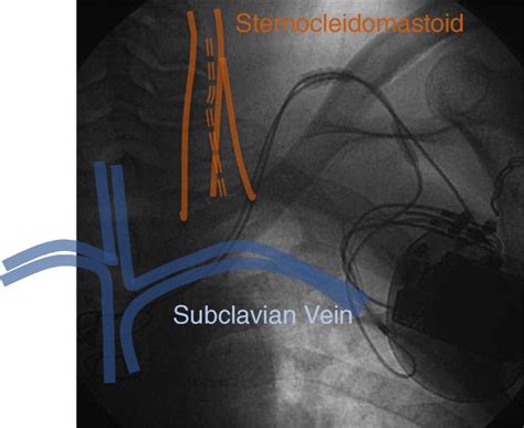 Subclavian Tunneled Access Approach Location Of Central Veins And Download Scientific Diagram