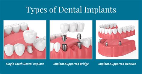 What You Should Know About Dental Implant Surgery Langley Dental