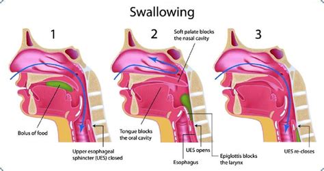 Dysphagia Types Symptoms And Causes