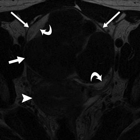 Mri Features Of Ovarian Fibroma And Fibrothecoma With Histopathologic Correlation Ajr