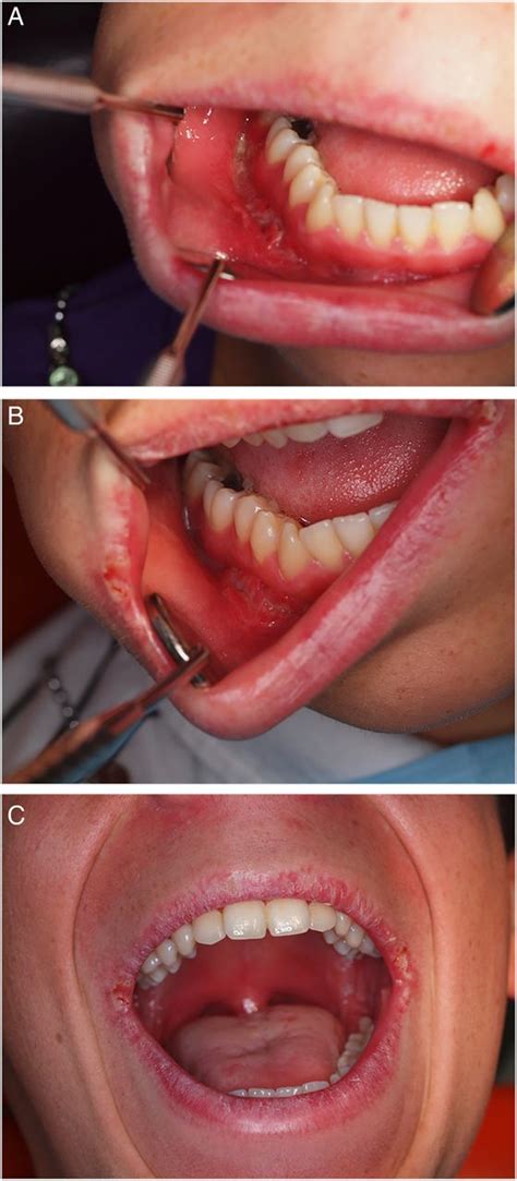 Oral Manifestations Of Crohn S Disease Bmj Case Reports