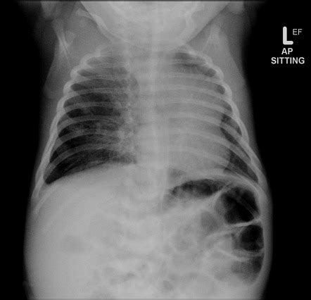 Congenital Pulmonary Airways Malformation Radiology Case