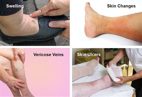 Understanding Chronic Venous Insufficiency Angeion Medical Aerowrap