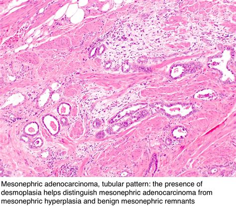 Pathology Outlines Mesonephric Adenocarcinoma