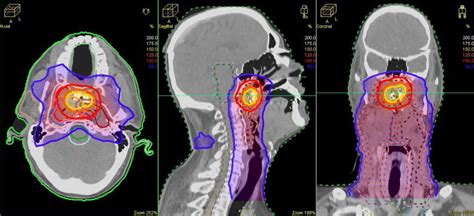 Dose Summation For A Nasopharyngeal Cancer NPC Case Treated With