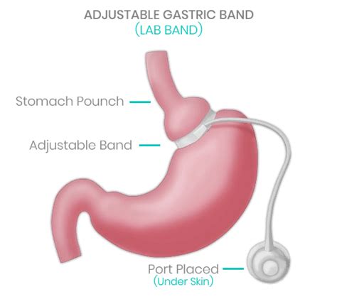 Gastric Band Lap Band Surgery In Tijuana Mexico Dr Lopez Corvala