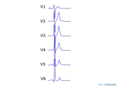 File Sqts Svg Ecgpedia