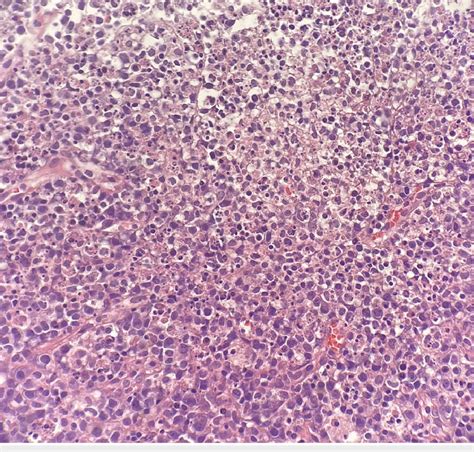 Hematoxylin Eosin Stained Section 10x Show Axillary Lymph Node With