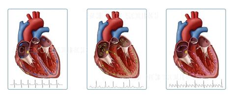 Photograph Heart AFib And Atrial Flutter Illust Science Source Images