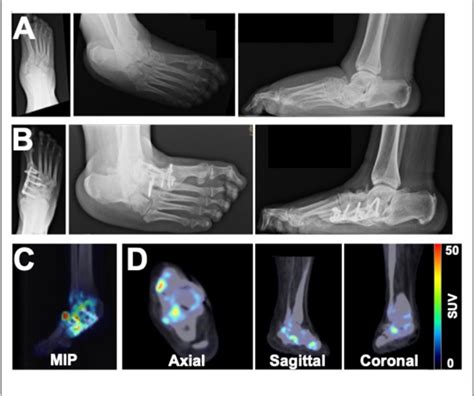 Figure From Novel Application Of F Naf Pet Ct Imaging For