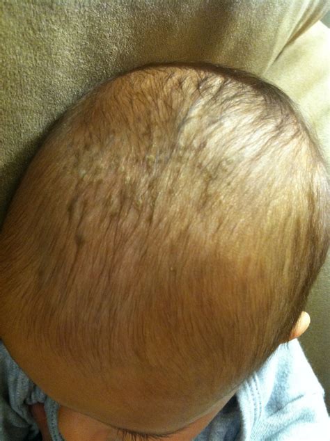 Goodbye Cradle Cap!
