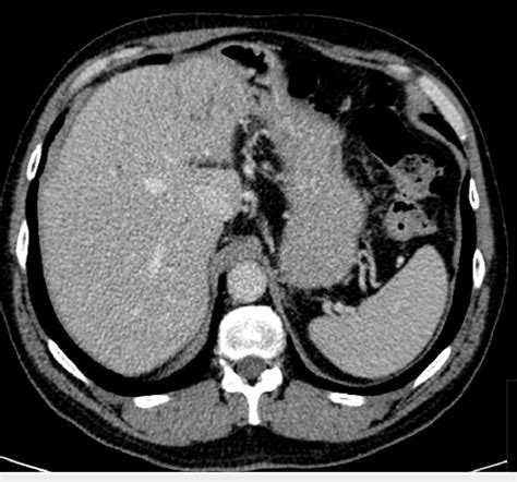 Normal Ct Scan Of The Abdomen Download Scientific Diagram