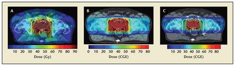 Proton Beam Therapy For Localized Prostate Cancer 101 Basics Controversies And Facts