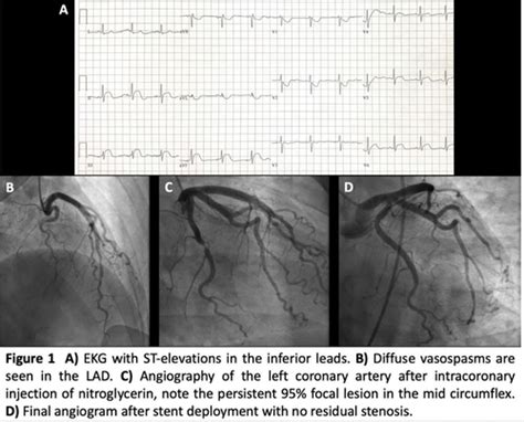 Vasospastic Angina Or Atherothrombotic Disease Cardiac Catheterization